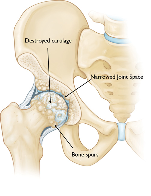 Hip Injuries Bursitis Fracture Arthritis Templeton Dr William Sima