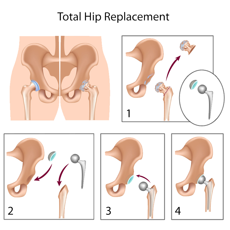 Hip Surgery Total Hip Replacement Templeton Dr William Sima Md
