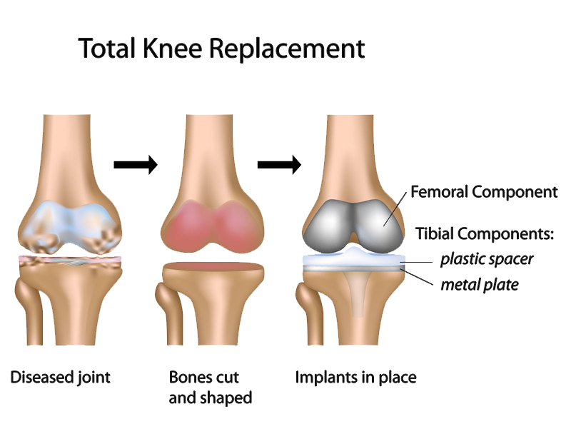 What is the recovery process for a minimally invasive total knee replacement?