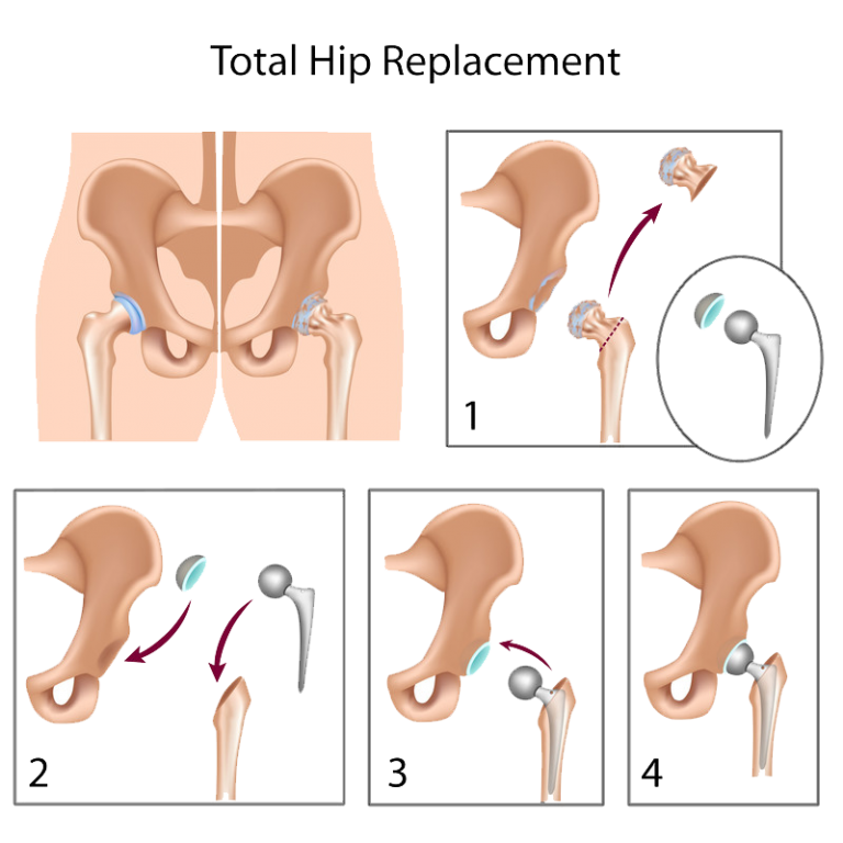 Hip Surgery Total Hip Replacement Templeton Dr William Sima, MD