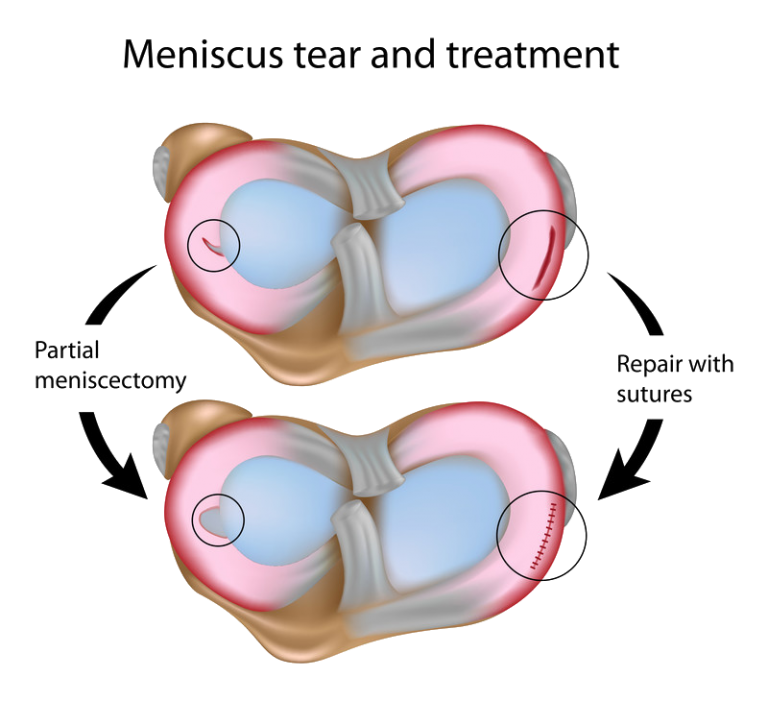 Knee Injuries - Meniscus - ACL - Running | Templeton | Dr William Sima