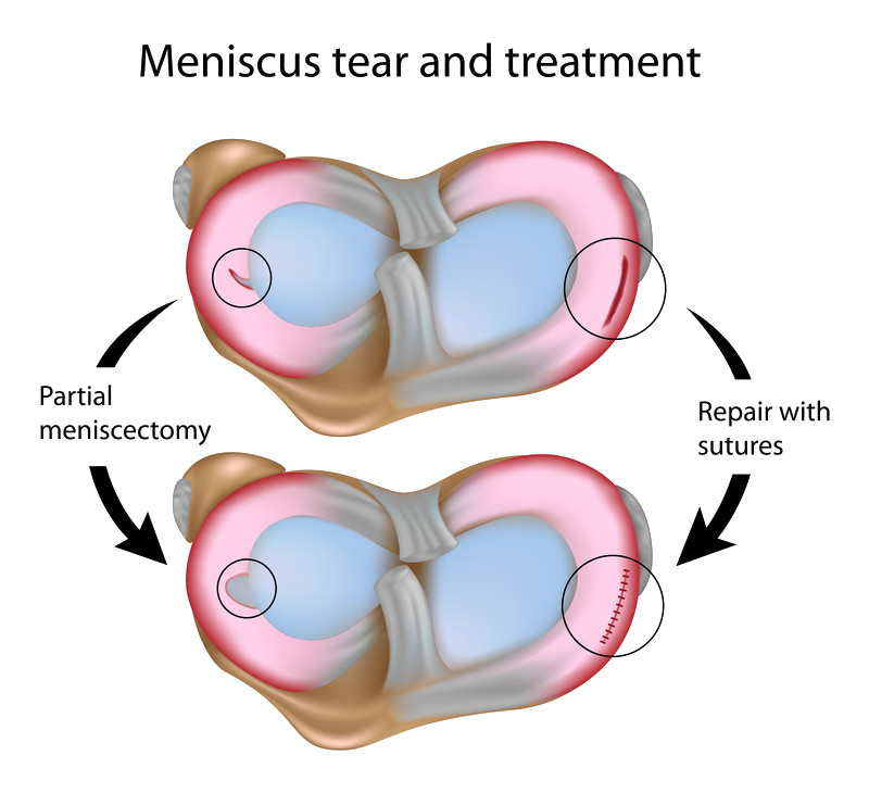 Knee Injuries Meniscus ACL Running Templeton Dr William Sima Knee Injuries Meniscus ACL Running Templeton Dr William Sima